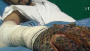 Could fish skin be used to bandage burns and ease the healing process?