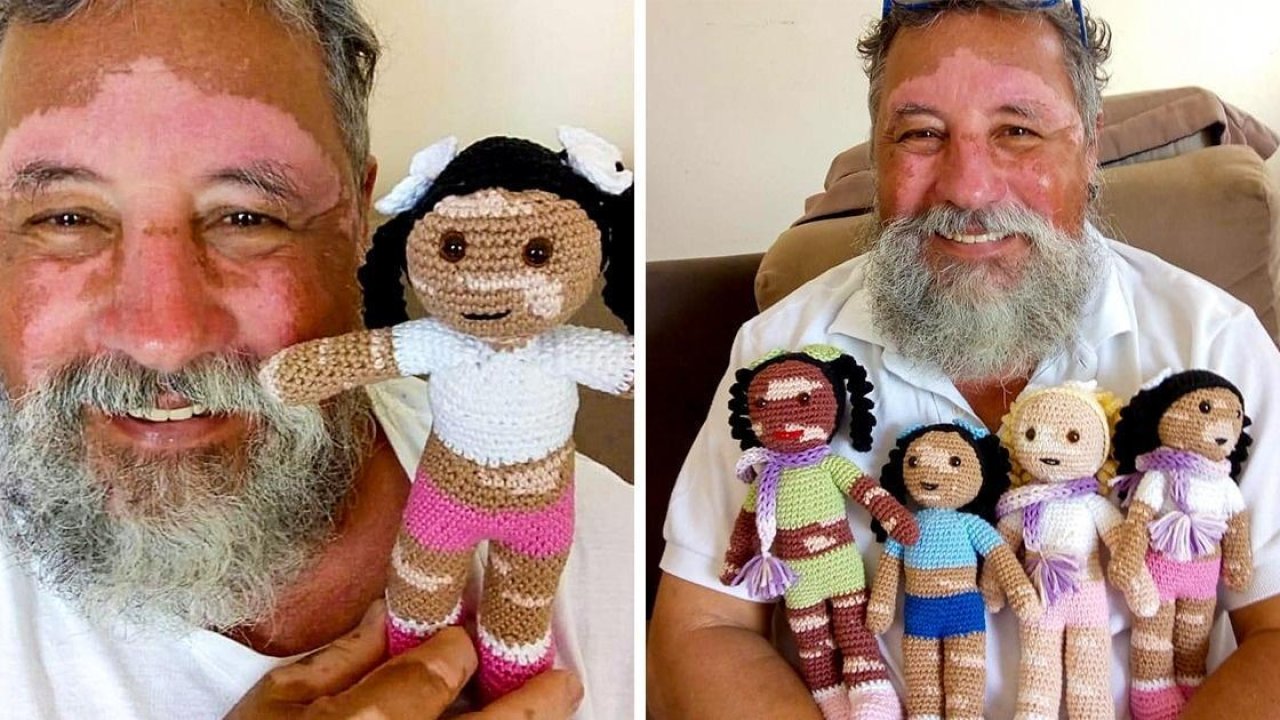 This grandfather with vitiligo crochets dolls for children with the same skin condition