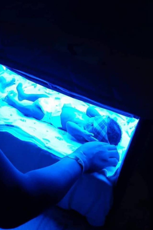 Jaundice is a liver condition where a baby’s skin and the white part of the eyes appear yellow due to excess bilirubin. Due to possible effects of untreated neonatal jaundice such as palsy, hearing loss and brain damage, instant treatment is recommended once diagnosed in new born babies using the Crib A' glow phototherapy unit designed for this purpose.
