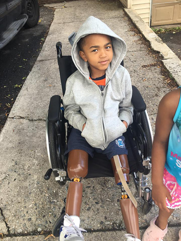 Kayden was born with Omphalocele, which caused his internal organs to grow outside his navel. The doctors told his mom to abort him because he was going to be in bad shape but instead she decided to save her son even though it meant causing his legs to be amputated.